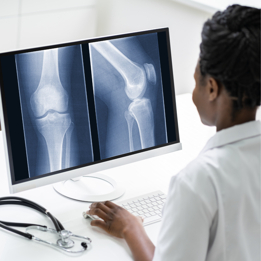 Can You Have a Normal X-ray but Still Have Knee Arthritis?