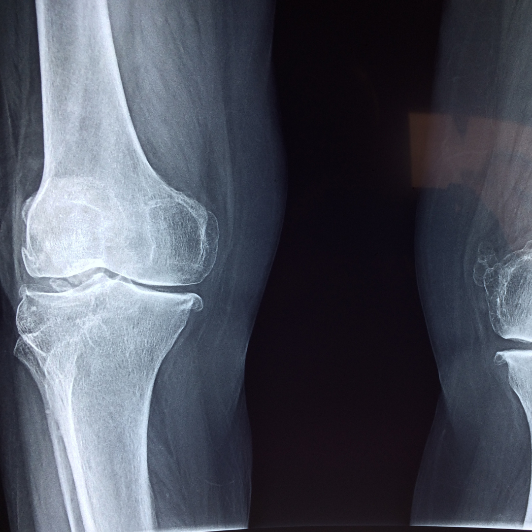 Does My Knee X-ray Mean I Need a Replacement?